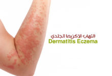 التهاب الاكزيما الجلدي - Dermatitis Eczema