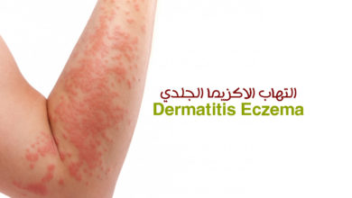 التهاب الاكزيما الجلدي Dermatitis Eczema 4 التهاب الاكزيما الجلدي - Dermatitis Eczema