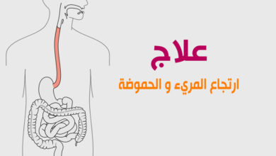 ارتجاع المريء والحموضة 25 ارتجاع المريء و الحموضة
