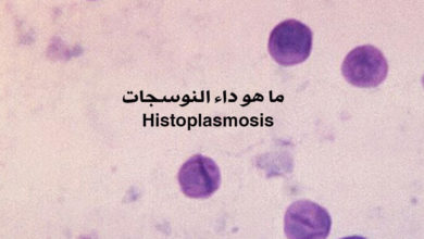 داء النوسجات Histoplasmosis 44 ما هو داء النوسجات Histoplasmosis