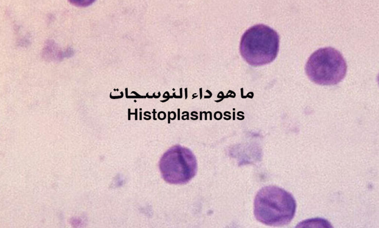 ما هو داء النوسجات Histoplasmosis