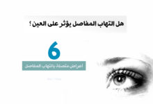 هل التهاب المفاصل يؤثر على العينين ؟