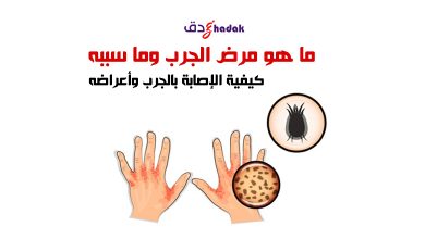 ما هو مرض الجرب وما سببه