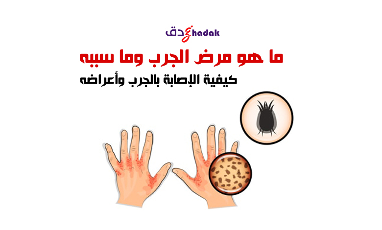 ما هو مرض الجرب وما سببه