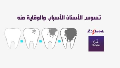 تسوس الأسنان الأسباب والوقاية منه 34 تسوس الأسنان الأسباب والوقاية منه