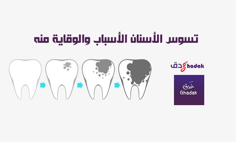 تسوس الأسنان الأسباب والوقاية منه