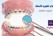 أنواع تقويم الأسنان المتوفرة والخيارات الأفضل 48 أنواع تقويم الأسنان المتوفرة والخيارات الأفضل