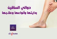 دوالي الساقين بدايتها وأنواعها وعلاجها 72 دوالي الساقين بدايتها وأنواعها وعلاجها
