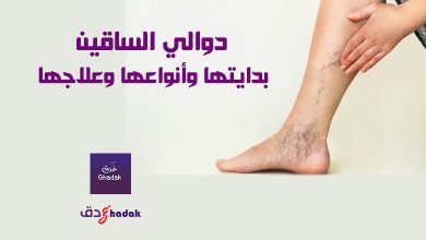 دوالي الساقين بدايتها وأنواعها وعلاجها 52 دوالي الساقين بدايتها وأنواعها وعلاجها