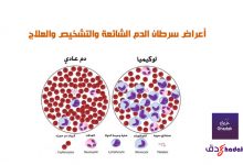 أعراض سرطان الدم الشائعة والتشخيص والعلاج 41 أعراض سرطان الدم الشائعة والتشخيص والعلاج