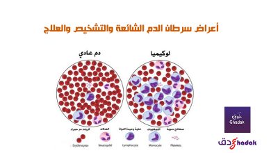 أعراض سرطان الدم الشائعة والتشخيص والعلاج 25 أعراض سرطان الدم الشائعة والتشخيص والعلاج