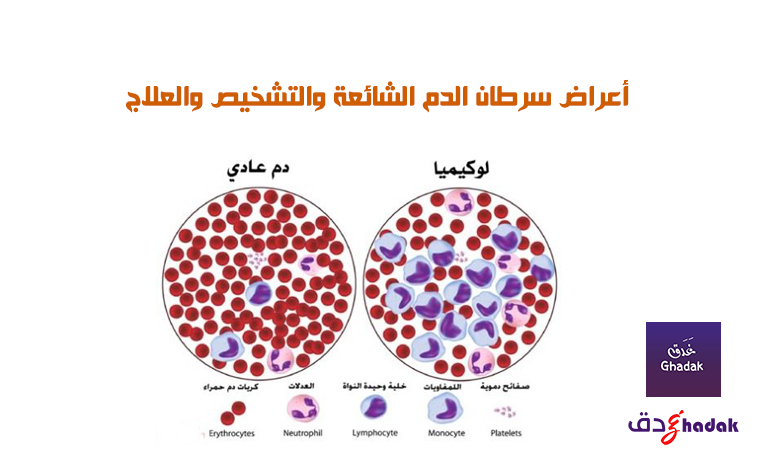 أعراض سرطان الدم الشائعة والتشخيص والعلاج