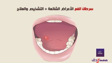سرطان الفم الأعراض الشائعة + التشخيص والعلاج 16 سرطان الفم الأعراض الشائعة + التشخيص والعلاج