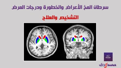 سرطان المخ الأعراض والخطورة ودرجات المرض 1 سرطان المخ التشخيص والعلاج