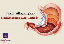 مرض سرطان المعدة - الأعراض والعلاج وعوامل الخطورة 78 مرض سرطان المعدة - الأعراض، العلاج وعوامل الخطورة