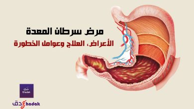 مرض سرطان المعدة - الأعراض والعلاج وعوامل الخطورة 8 مرض سرطان المعدة - الأعراض، العلاج وعوامل الخطورة