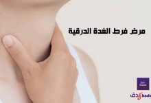 مرض فرط الغدة الدرقية Hyperthyroidism 52 مرض فرط الغدة الدرقية