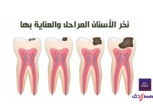 نخر الأسنان المراحل والعناية بها 95 نخر الأسنان المراحل والعناية بها
