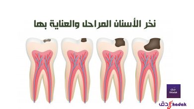 نخر الأسنان المراحل والعناية بها 48 نخر الأسنان المراحل والعناية بها